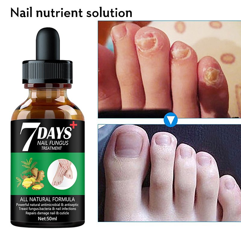 7DAYS Nail Fungus Treatment Serum Care Hand And Foot Care Removal - Image 6