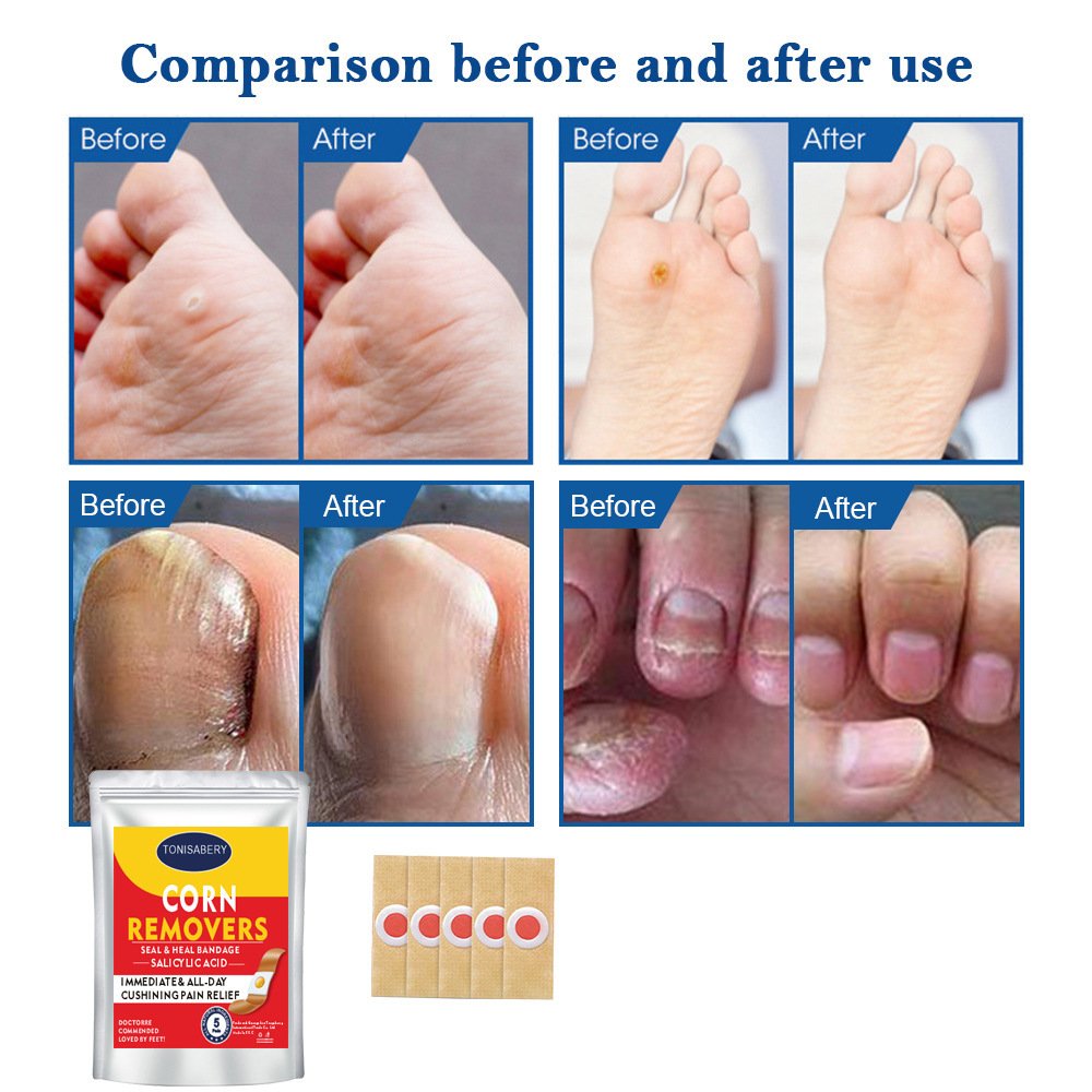 Foot Care Corn Removal Cream Set - Image 2