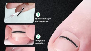 1Pcs Nail Correction Stickers Ingrown Toenail Corrector Patches Invisible High Strength Auxiliary Patch Paronychia Treatment
