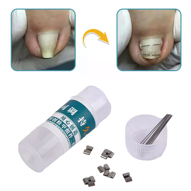 Ingrown Toenail Corrector Tools Pedicure Recover Embed Toe Nail Treatment Professional Ingrown Toenail Straightening Clip Brace - Image 2