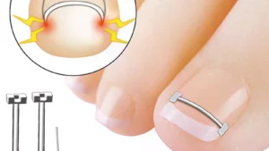 Ingrown Toenail Corrector Tools For Pedicure Recover Embed Toe Nail - Professional Toe Nail Straightening Clip Tool
