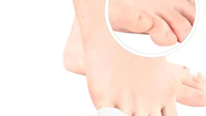 1 Pair Silicone Toe Separators & Little Toe Protectors for Bunionette Straightening