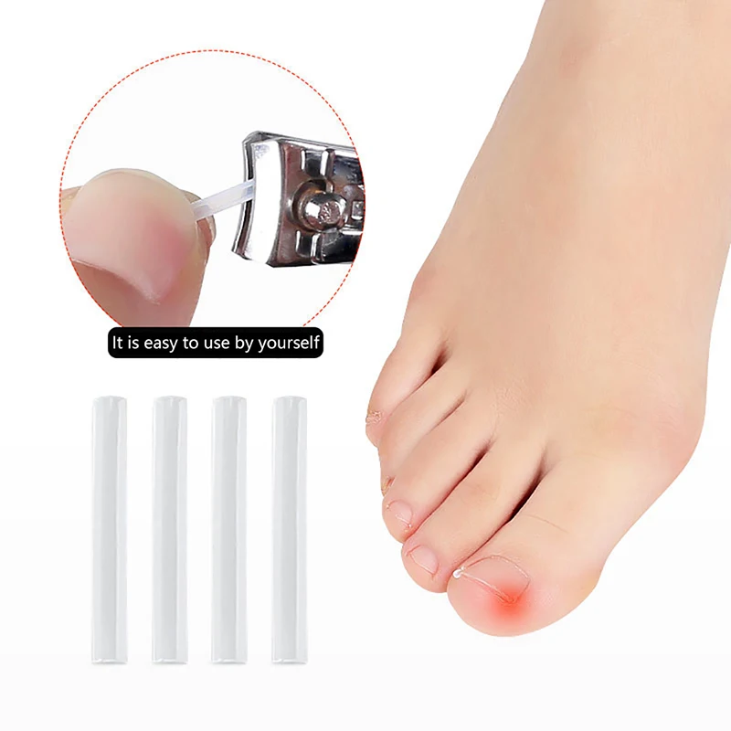 10/20/30/50Pc Toenail Correction Ingrown Toenail Correction Invisible Ingrown Toe Nail Treatment Elastic Straightening ClipBrace - Image 2