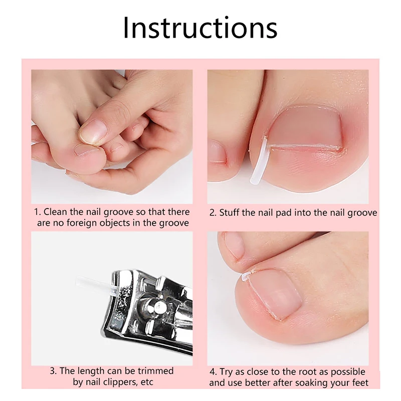 10/20/30/50Pc Toenail Correction Ingrown Toenail Correction Invisible Ingrown Toe Nail Treatment Elastic Straightening ClipBrace - Image 5