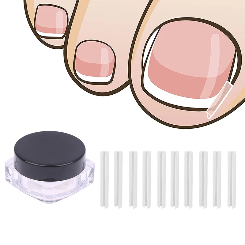 10/20/30/50Pc Toenail Correction Ingrown Toenail Correction Invisible Ingrown Toe Nail Treatment Elastic Straightening ClipBrace - Image 6