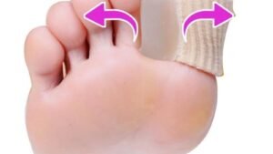 Hallux valgus orthosis