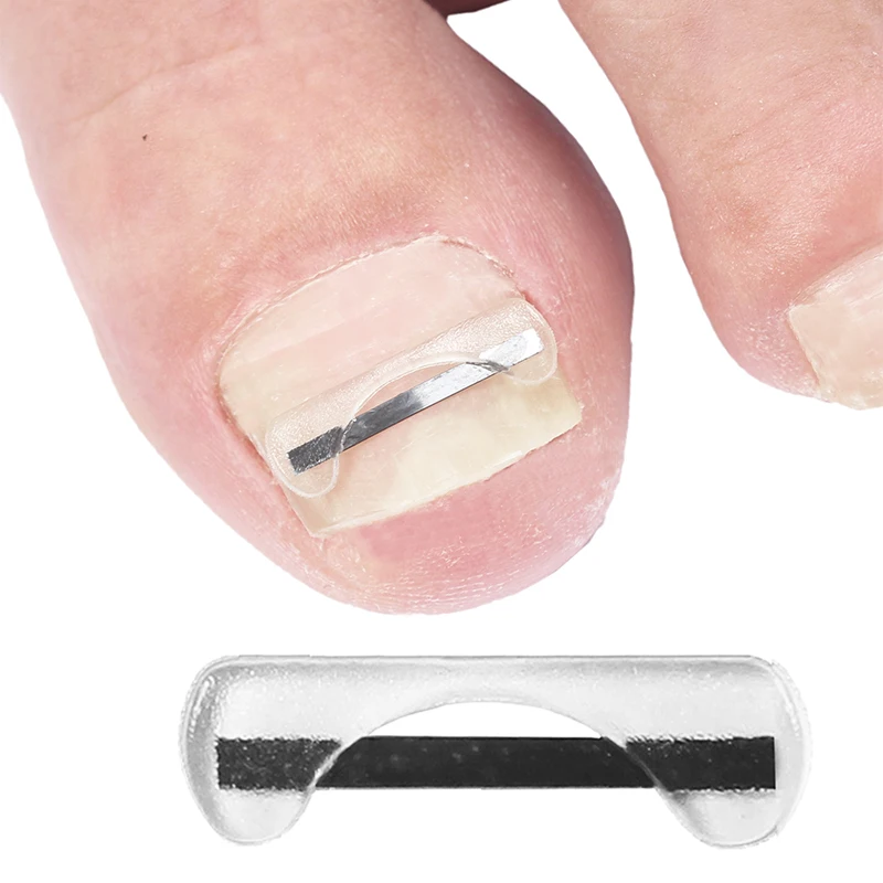 Toenail Correctors Titanium Alloy Toenail Correction Wire Ingrown Nail Treatment Device Stickers Silicone Tool Foot Care - Image 3
