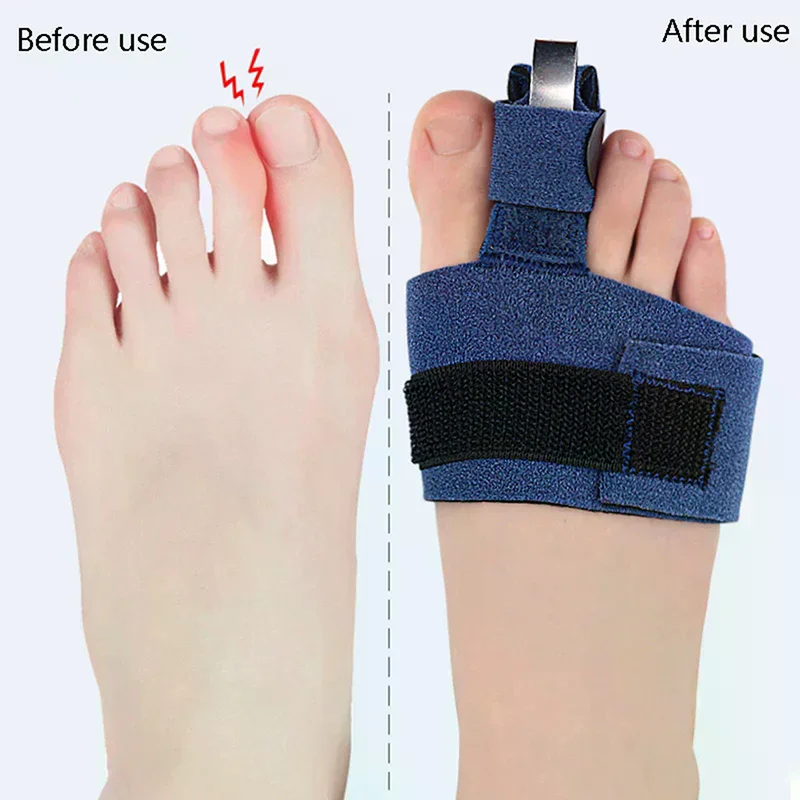 1Pcs Toe Corrector Toe Fracture Fixator Orthotics Foot Bone Thumb Adjuster Correction Soft Pedicure Socks Bunion Straightener - Image 2