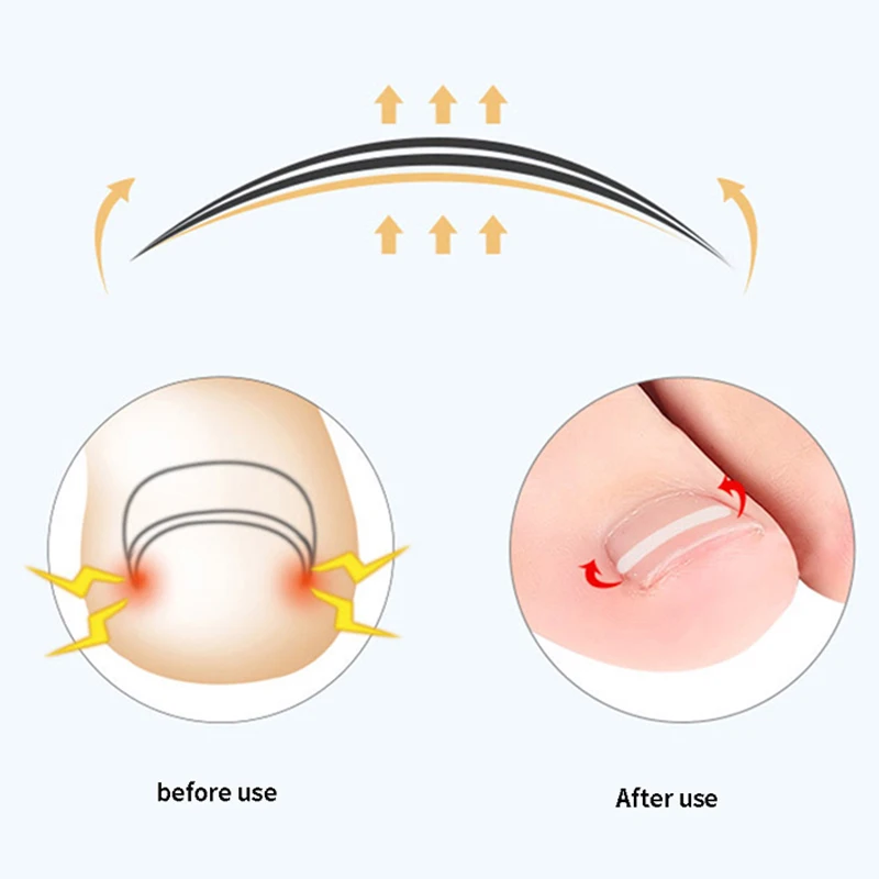 10 pcs Ingrown Toe Nail Treatment Ingrown Toenail Correction Tool Elastic Patch Sticker Straightening Clip Brace Pedicure Tools - Image 6